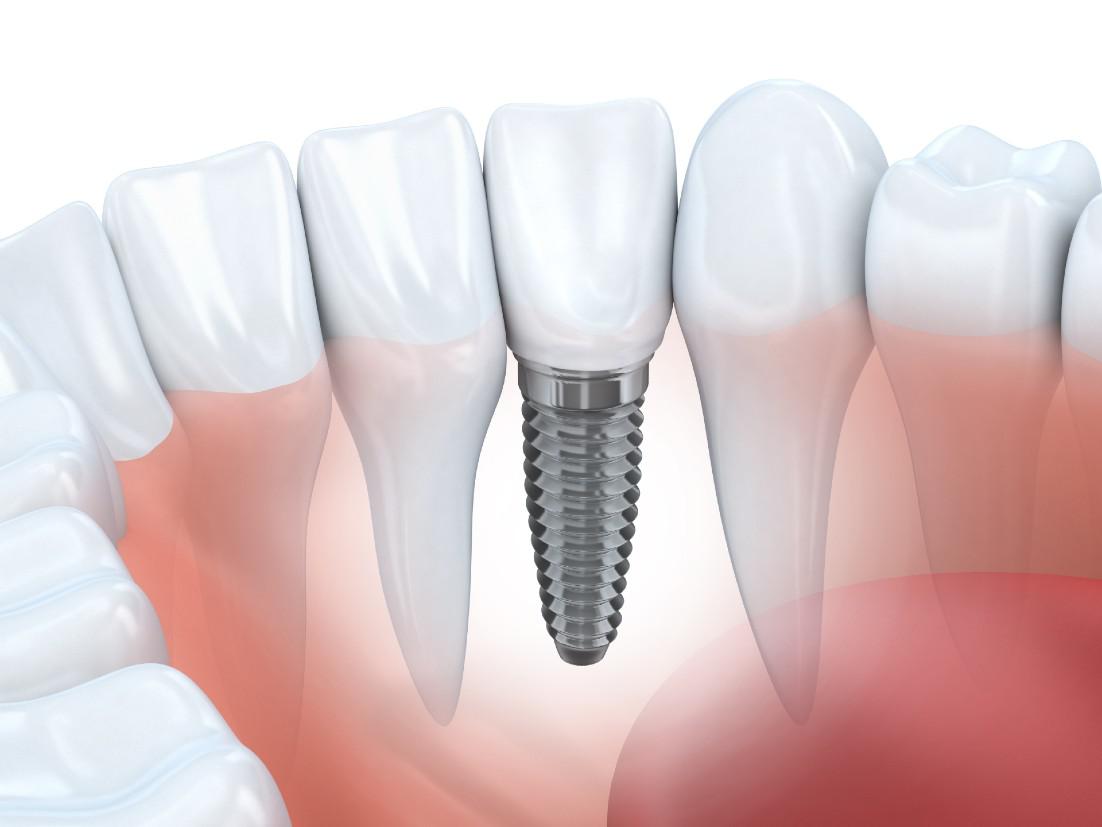 Dental Implants Blue Bell, PA